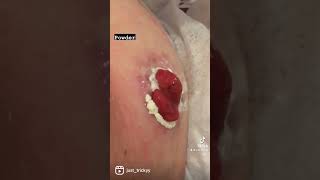 Stoma care ileostomy skin help [upl. by Batruk]