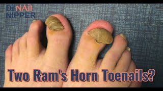 Rams Horn Toenail Are You Excited 2020 [upl. by Gennie402]