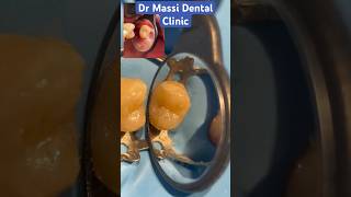 Dental composite filling oralhealth vibes smile composite bondingfyp youtubeshorts fyp [upl. by Erfert802]