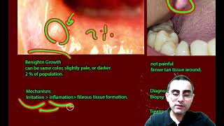 Oral Irritated Fibroma  Firm bump in the mouth Symptoms causes and treatment [upl. by Kuhlman]