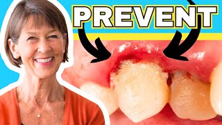 How To Treat Gingivitis And Gum Recession At Home [upl. by Ocnarfnaig]