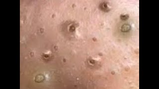 👀 How to remove blackheads form nose treatment Comfortable satisfied with relexing amp aSurprise 💥 [upl. by Zack]