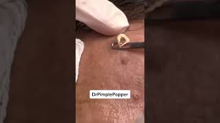 A Win is a Win Dr Pimple Popper ForeheadPop [upl. by Noied979]