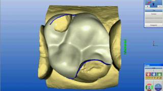 Making of an onlay CEREC [upl. by Ahseiym]