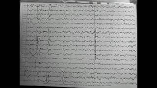 Paroxysmal epileptiform activity in eeg of a child with medication refractory epilepsy [upl. by Einaoj]