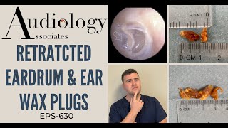 RETRACTED EARDRUM amp EAR WAX PLUGS  EP630 [upl. by Gnilrits]