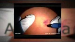 VeinGogh  Spider Angioma Treatment [upl. by Ailin]