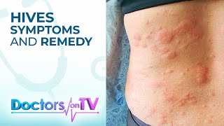 Hives Symptoms and Remedy  DOTV [upl. by Bolte]