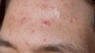 What Are Alternatives to Accutane  Acne Treatment [upl. by Dorita568]