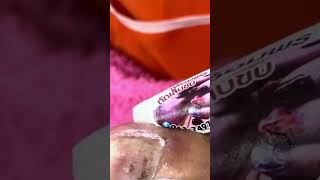 Professional ingrown toenail procedure video 006 [upl. by Neitsabes455]