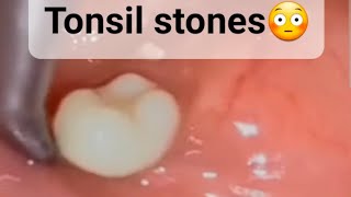 Bad BreathTonsil Stones😳 [upl. by Ly]