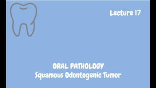 Squamous Odontogenic Tumor Complete Lecture  For NBDE NDEB MDS amp FCPS [upl. by Libbey936]