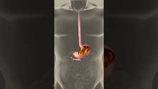 Animation What ACID REFLUX Really Looks Like Inside Your Body [upl. by Ribaudo]