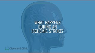 What Happens During an Ischemic Stroke [upl. by Aleece]