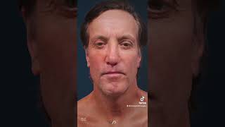 TRACELESS FACE amp NECK LIFT Before and After  Proof You NEED It [upl. by Fitts802]