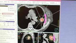 Stereotactic Radiotherapy Lav Goyal MD Radiation Oncologist [upl. by Eiramlirpa]