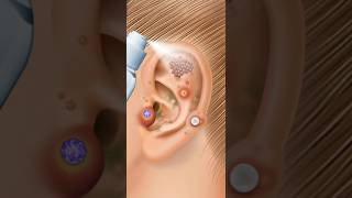 ASMR ear treatment remove worm amp piercing cleaning pimple pus 2d animation [upl. by Coltun]