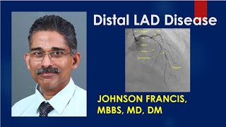 Distal LAD Disease [upl. by Mattson]