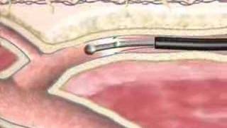 Varicose Veins Closure Procedure at BIDMC [upl. by Hairahcez]