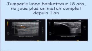 Intérêt de léchographie dans les injections de PRP par le Pr Philippe Peetrons [upl. by Calmas]