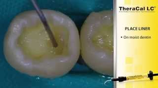 Direct Composite Placement Using TheraCal LC and AllBond Universal [upl. by Michelsen156]