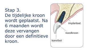 Immediaat Implantaat behandeling  Voortand vervangen [upl. by Eichman]