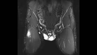 Athlete with rectus femoris tear [upl. by Arihsat]