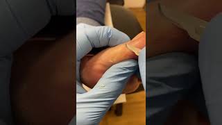 Big toe callus removal by australian  Podiatrist with a scalpel [upl. by Ymled]