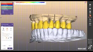 Dolphin AudaxcephDigistell ImplastationSmiledesigner ProBlenderforDentalBlueskyplan [upl. by Calondra994]