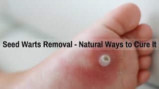 Seed Warts Removal  Natural Ways to Cure It [upl. by Fujio646]