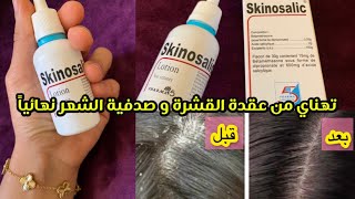 تجربتي مع SKINOSALIC تهنيت من قشرةالشعر والصدفية من اول استعمال طريقتي في استعمالو لنتائج مبهرة [upl. by Eittocs571]