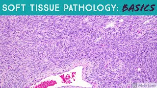 Basic Soft Tissue Pathology Cases Explained by a Sarcoma Pathologist [upl. by Satsoc]