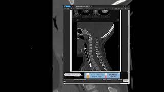 Atlantooccipital dissociation [upl. by Soinski]