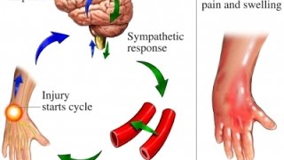 Complex Regional Pain Syndrome CRPS [upl. by Angadresma]