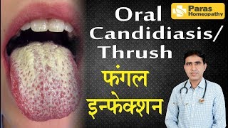 Oral Thrush Treatment  Medicine For Oral Fungs  White Coated Tongue [upl. by Sosthenna857]