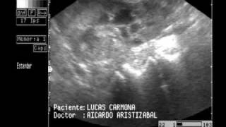 ECOGRAFIA LINFOSARCOMA RENAL [upl. by Phillis]