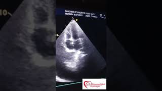 Constrictive pericarditis Echo  CP Echo  Echocardiography toacs  constrictive pericarditis [upl. by Nyloj]