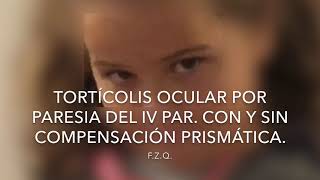 Tortícolis ocular en paresia del IV par Con y sin compensación prismática [upl. by Annaek]