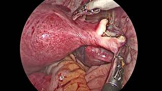 Laparoscopic Right Salpingectomy [upl. by Oderfodog]