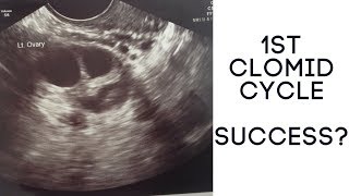 1ST CLOMID CYCLE  SUCCESS  THE RALLS FAMILY [upl. by Letitia]