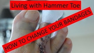 HammertoeHOW TO CHANGE YOUR BANDAGES [upl. by Akeihsal]