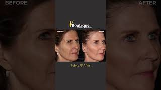 VBoutique  Before and After Video Dysport Sculptra Microneedling [upl. by Ardyce]