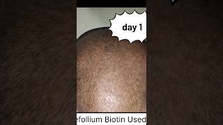 biotin hair growth results before and after  biotin side effect  refollium biotin results  biotin [upl. by Lemor]