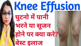 Knee Effusion  घुटने में पानी भरनासूजन का इलाज  Knee Effusion Causes And Treatment  Swollen Knee [upl. by Ran978]