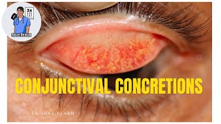 Conjunctival Concretions What are they Eye Dr Explains [upl. by Airt828]