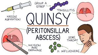 Understanding Quinsy Peritonsillar Abscess [upl. by Vesta]