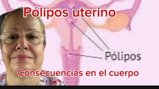 Pólipos uterinos Consecuencias en el cuerpo [upl. by Oriel376]