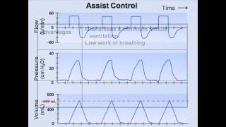 Ventilator Modes Mechanical Ventilation  Lecture 7 [upl. by Eerrahs]