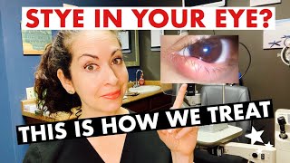 STYES  What are they and how are they treated  The Eye Surgeon [upl. by Dukey]