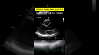 Dilated Aortic Root with Aortic Regurgitation in patient with Marfan syndrome echocardiography [upl. by Kacerek74]